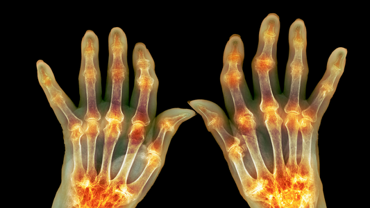 X-ray image of hands showing inflammation and joint damage caused by arthritis the inflammatory disease